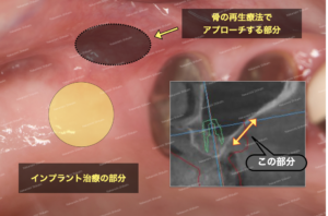 骨再生・造成の方法は、処置予定の横あたりからアプローチしていきます
